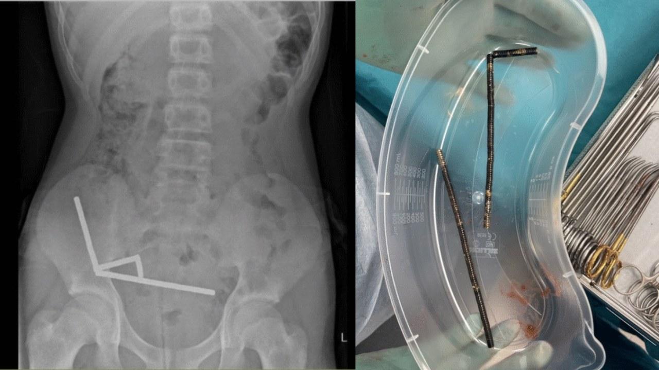 新西蘭男童吞200磁鐵劇烈腹痛 切除部份腸道脫離險境。(新西蘭醫學雜誌)
