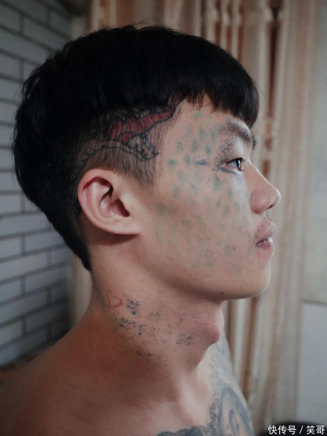 「紋面男孩」夏朝勇清洗3次紋身後,臉部大部分刺青已經褪去。