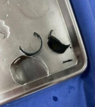 經過一番努力,兩個環圈終移除。(互聯網)