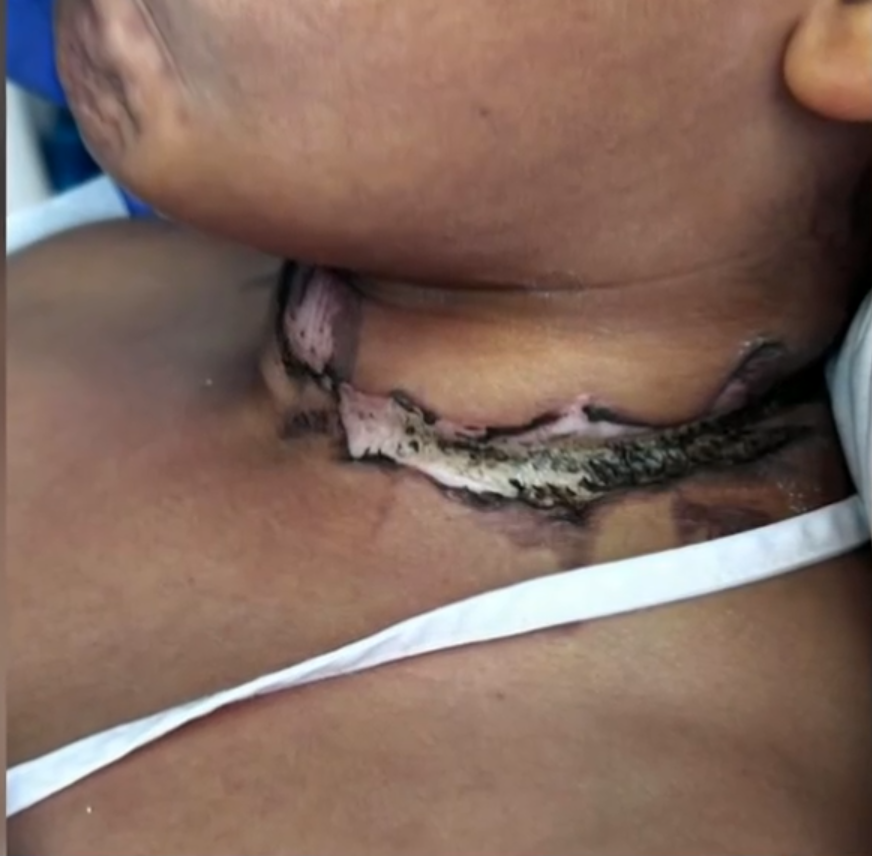 頸鍊纏住平板充電線起火 睡夢中驚醒男童頸燒燶