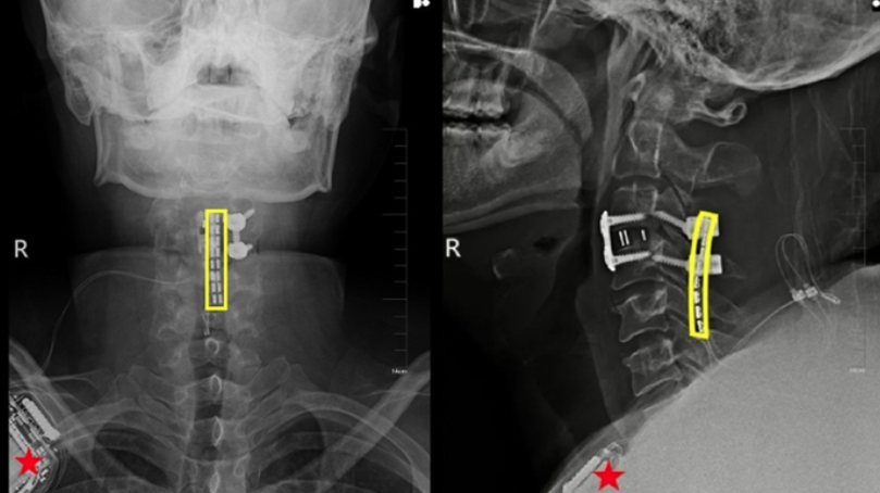 「脊髓介面技術」是指在損傷部位,精準植入微型電極裝置。(互聯網)