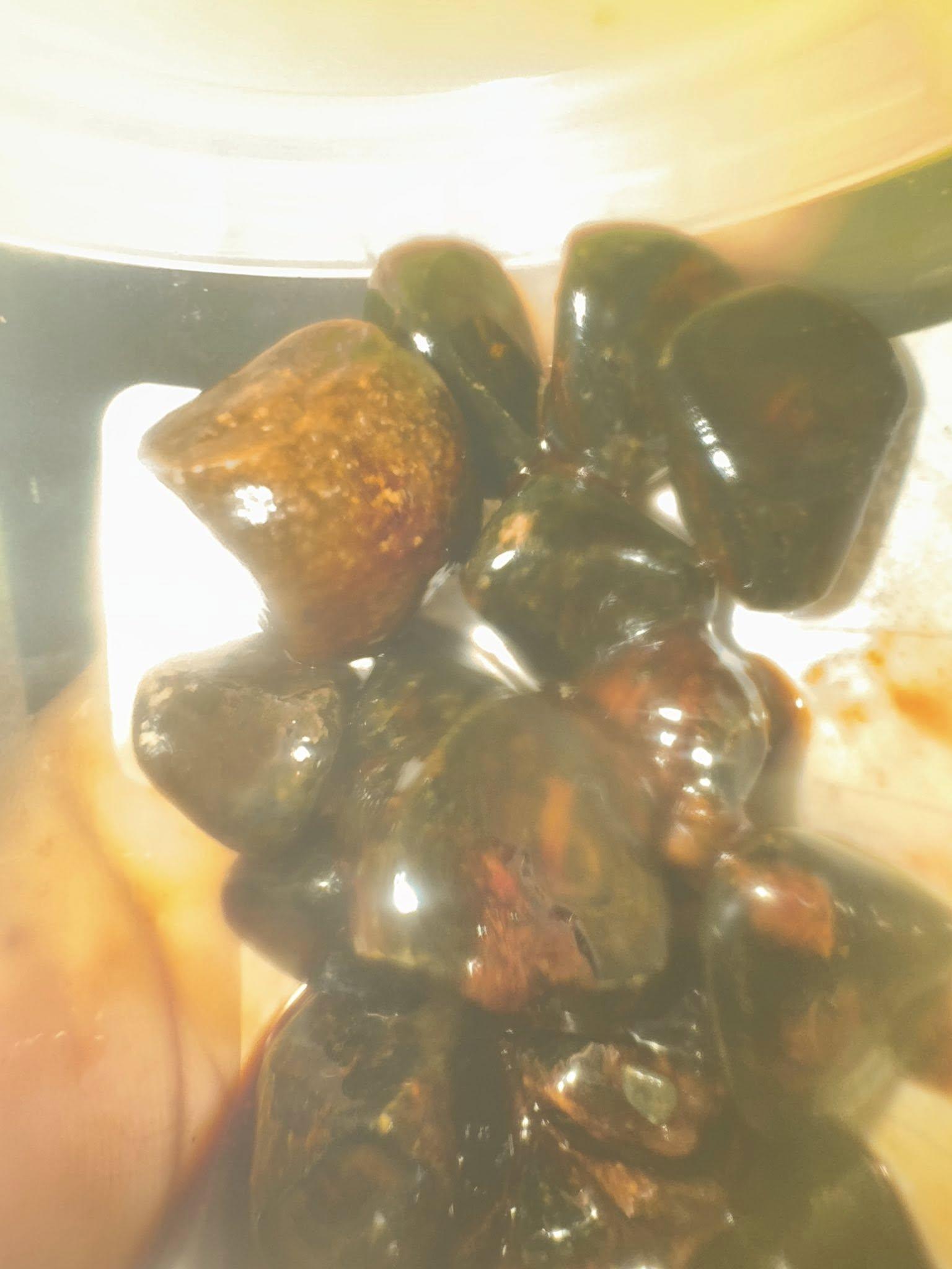 李佳的膽石數量驚人。