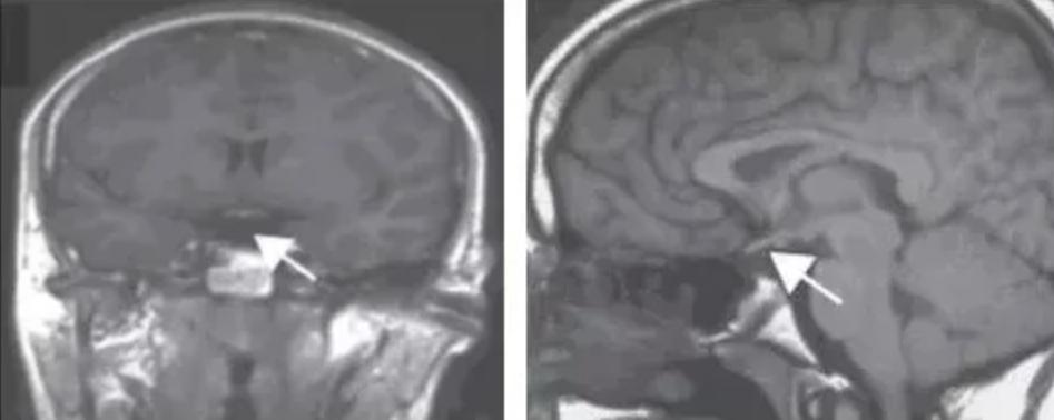 垂體柄阻斷綜合症屬於罕見病,需要做磁共振檢查才能確診。(丁香園)