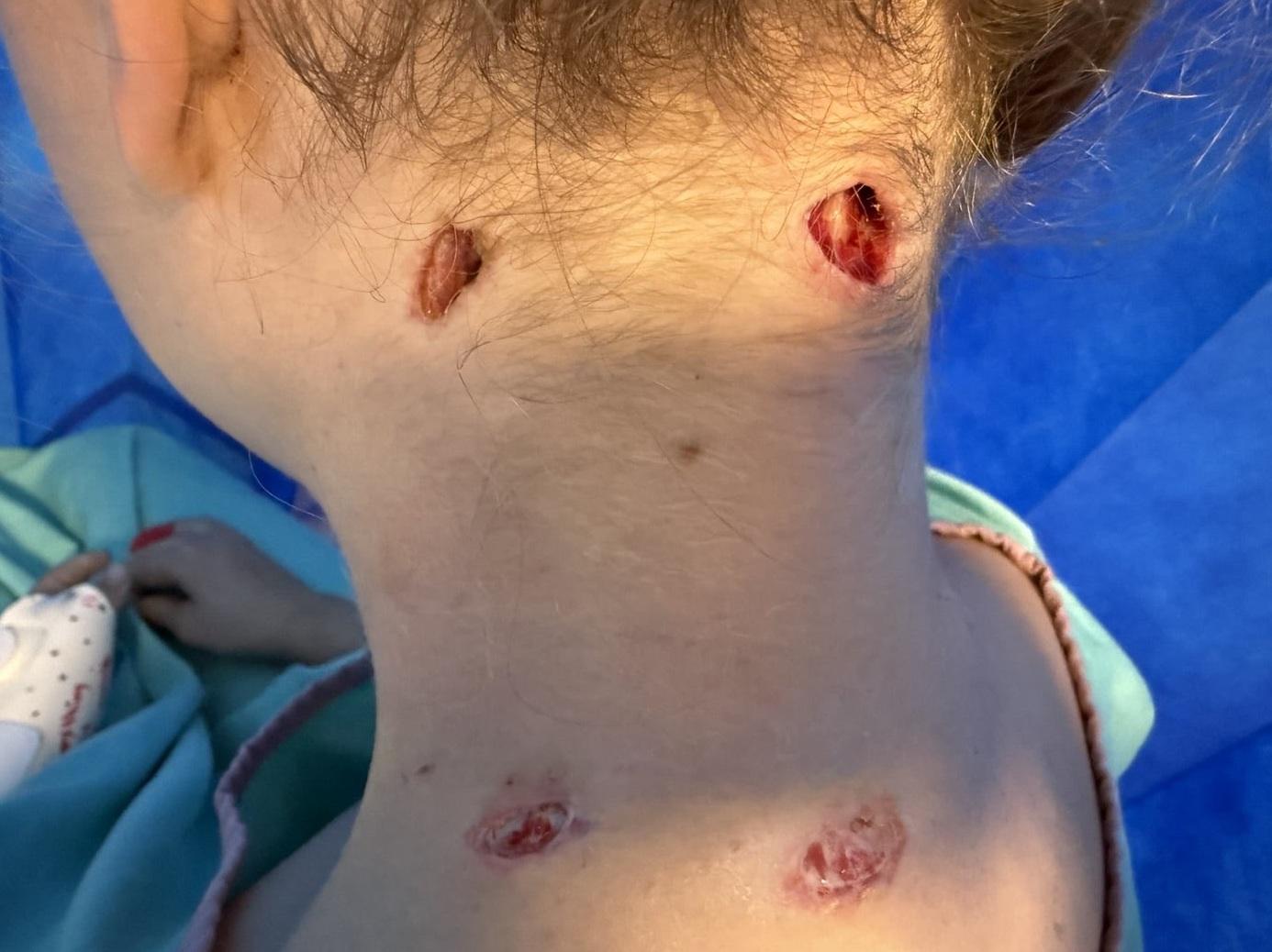 博伊頸部被獅子咬傷,傷口見骨發炎。(互聯網)