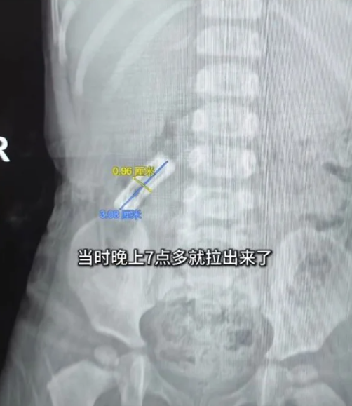 女童吞下髮夾,但醫生擔心麻醉及胃鏡有風險。(互聯網)