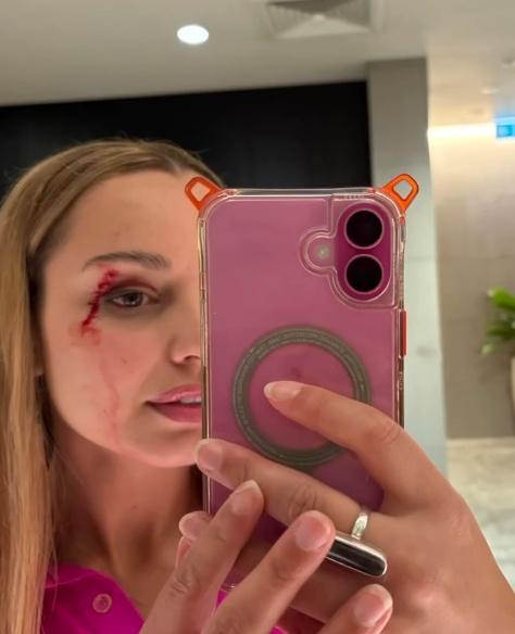 Jessica Tyson的左眉上方的傷口還在流血。(IG)