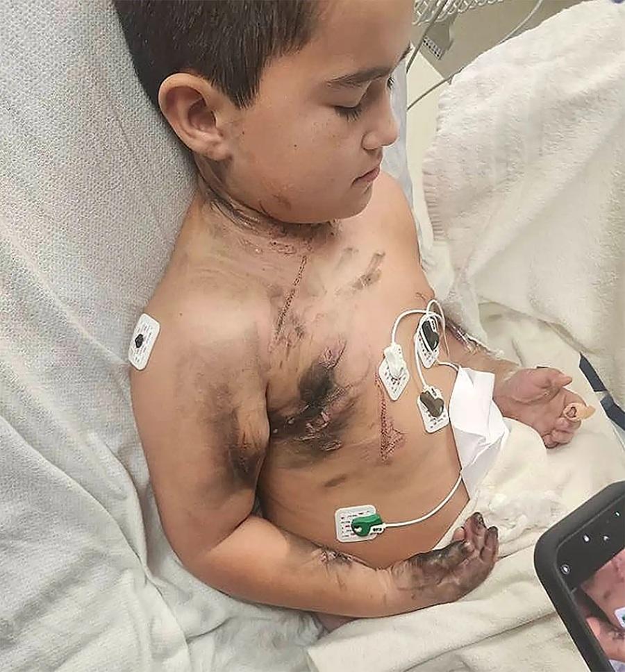 8歲童睡覺頸鏈卡手機充電器觸電 及時扯下頸鏈撿回一命