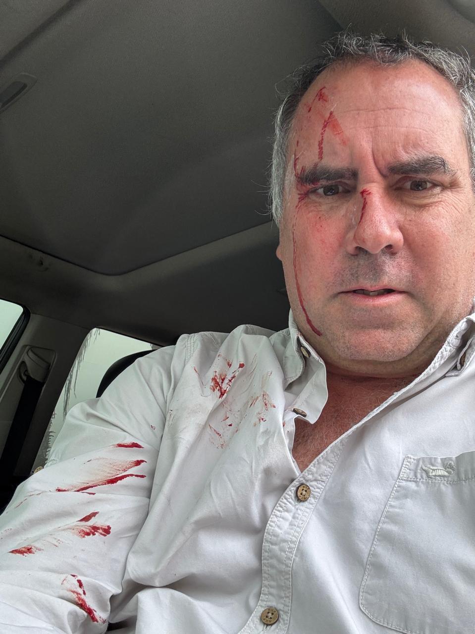 秘魯總統候選人貝勞德聲稱被槍聲,臉上及衣服有少量血漬。