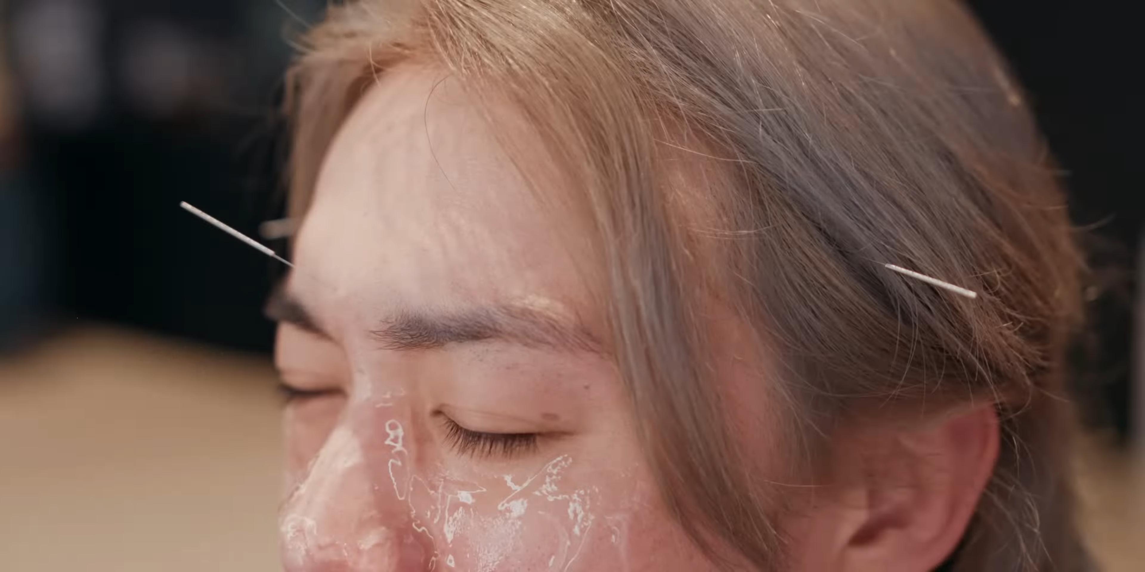 《今繼》MV穿插Jer柳應廷籌備演唱會的花絮,他於開show前感冒,需接受針灸治療。(MV截圖)