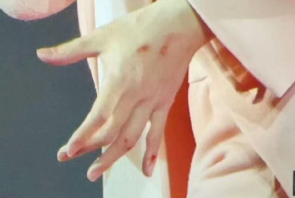 阿信的手滿是傷痕、手指也濺血。