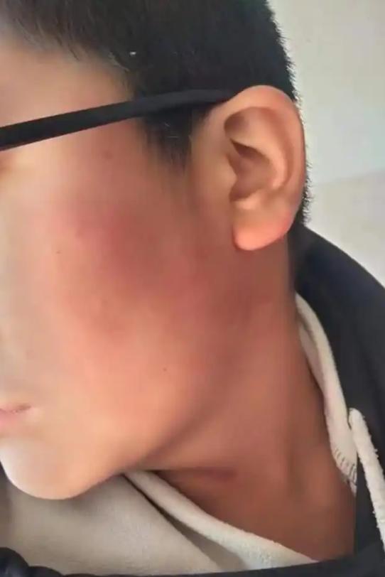 涉事13歲學生被打後臉部出現大型紅印。