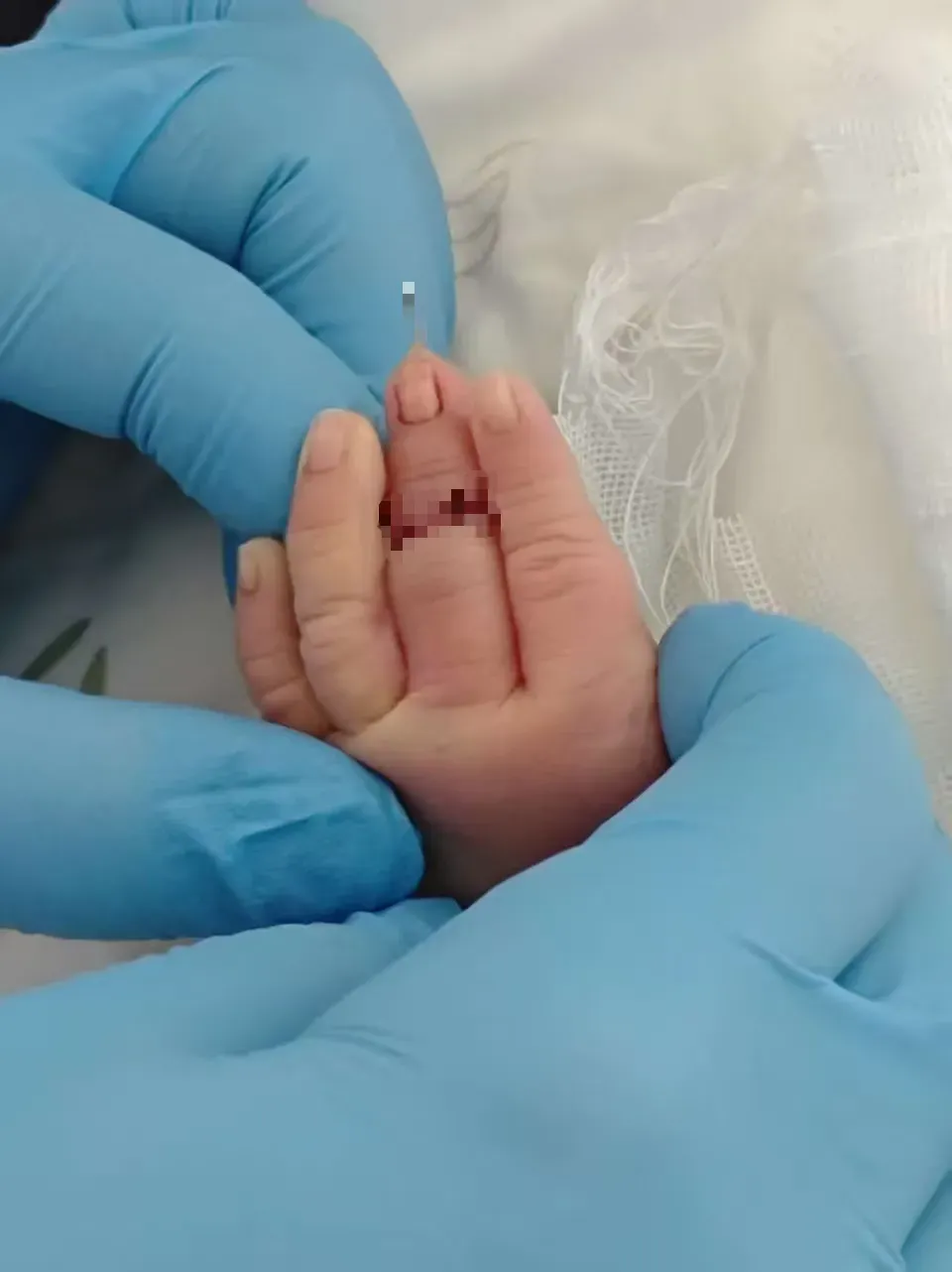 男嬰手指遭剪斷。(網易)