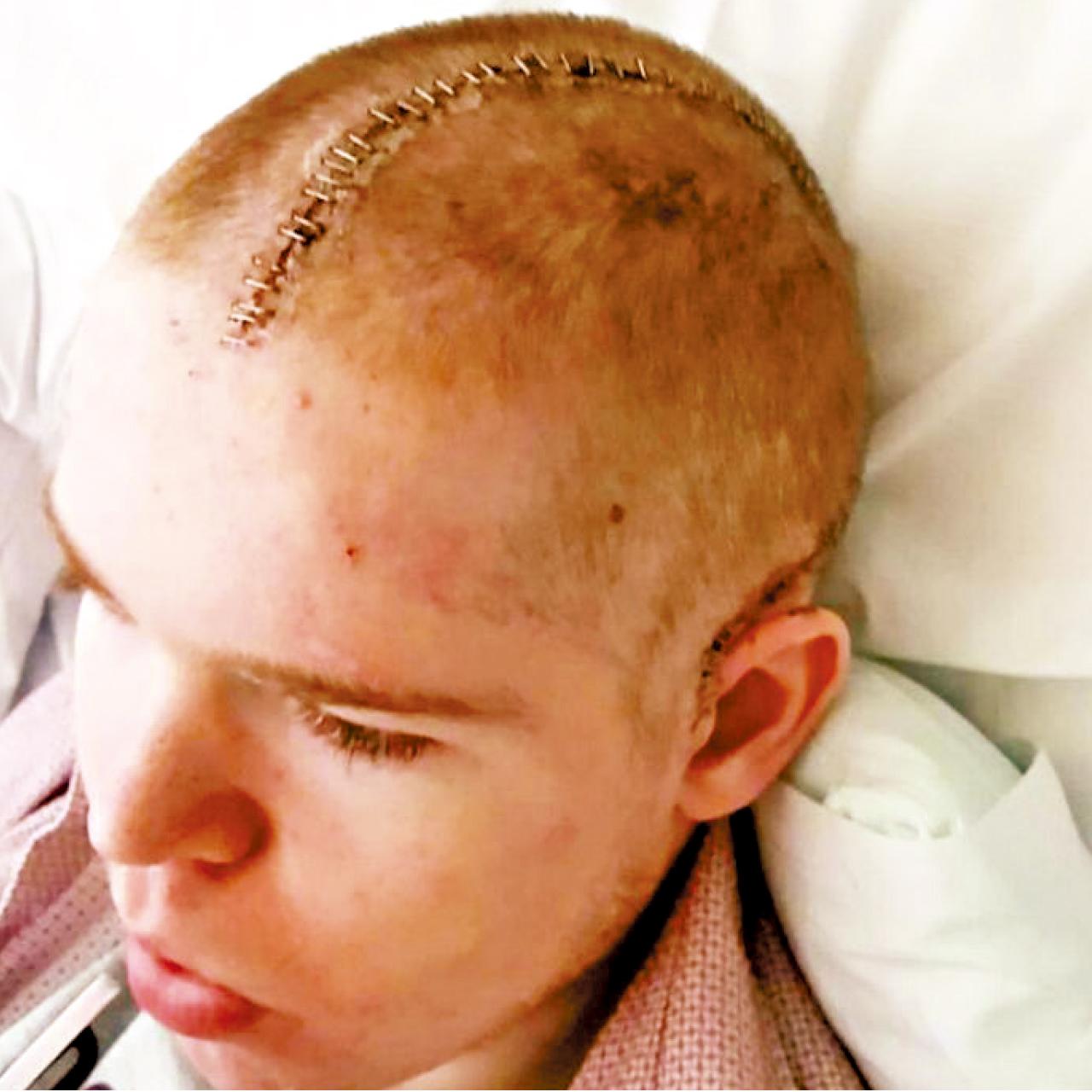 腦部植入鈦板重建頭顱形狀。