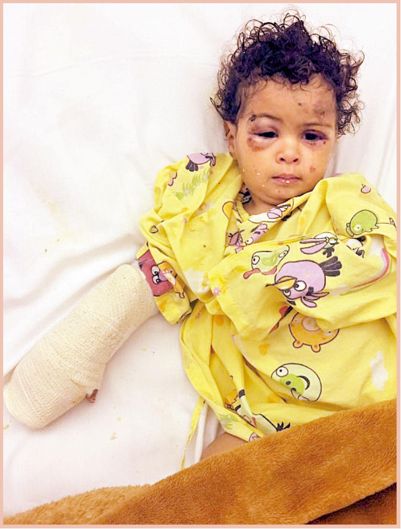 扎胡爾當日截除手指後,躺在病床。