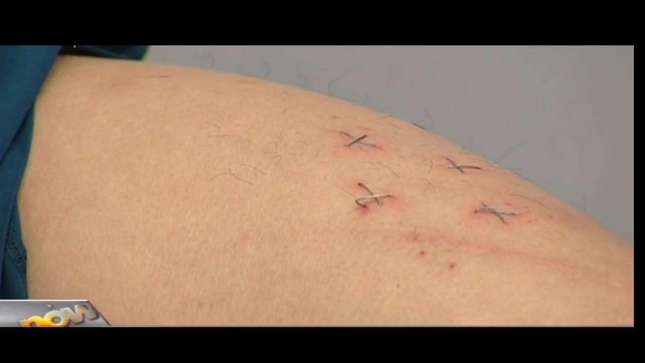 林子健大腿上十字釘傷 (NOW片段截圖)