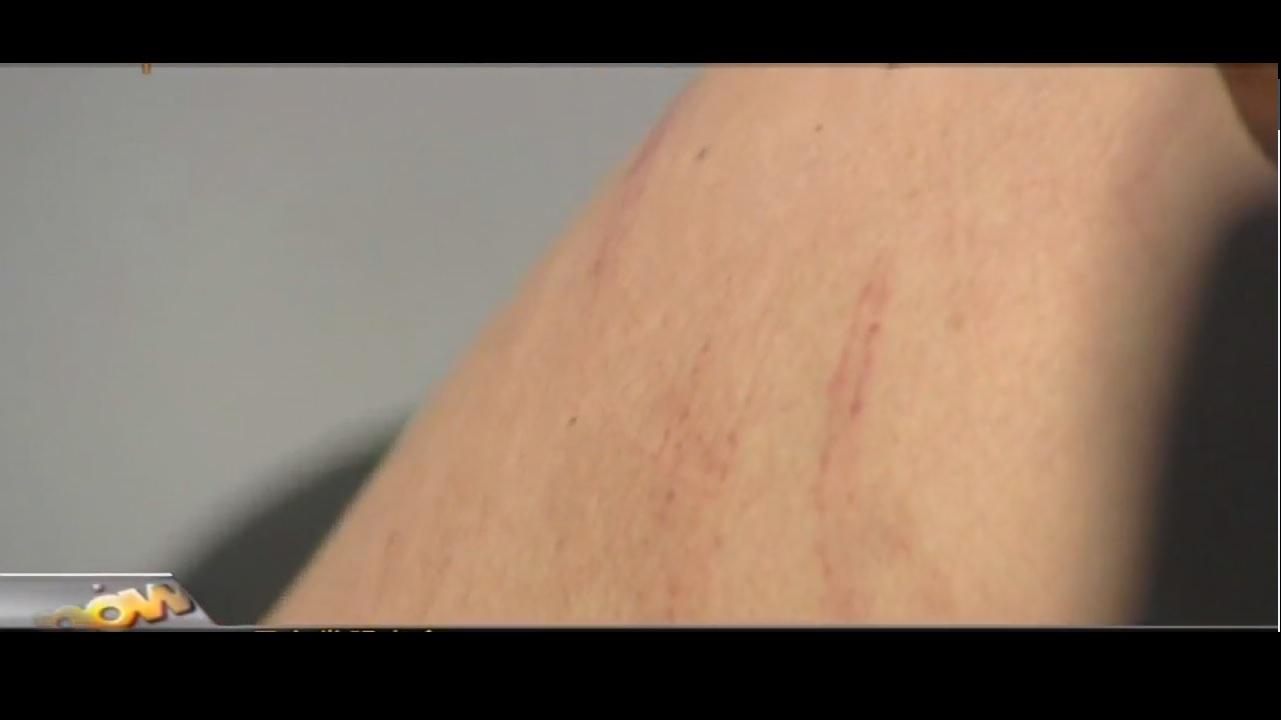 林子健腹部瘀傷 (NOW片段截圖)