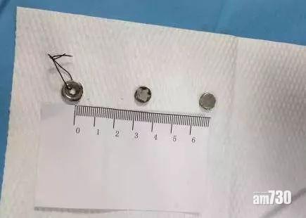 醫生用更大的磁鐵(左),將兩顆磁鐵吸出。(互聯網)