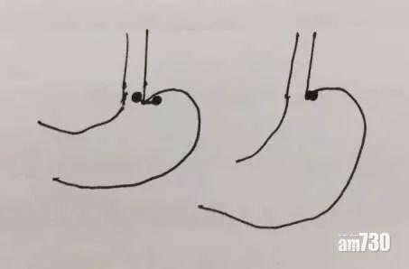 兩顆磁鐵先後掉落胃部,相吸時將胃弄穿。(互聯網)