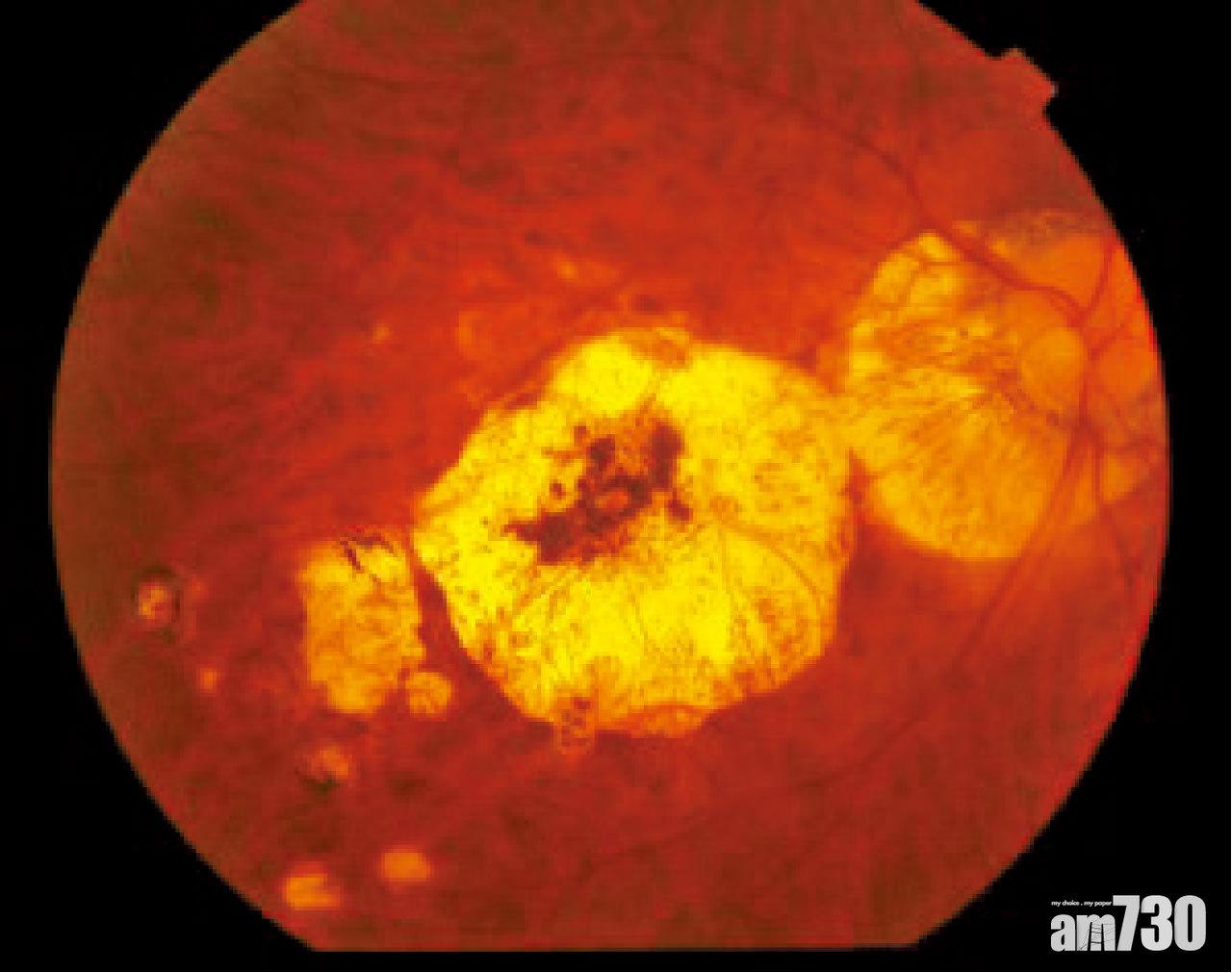 深度近視眼底病變的情況。