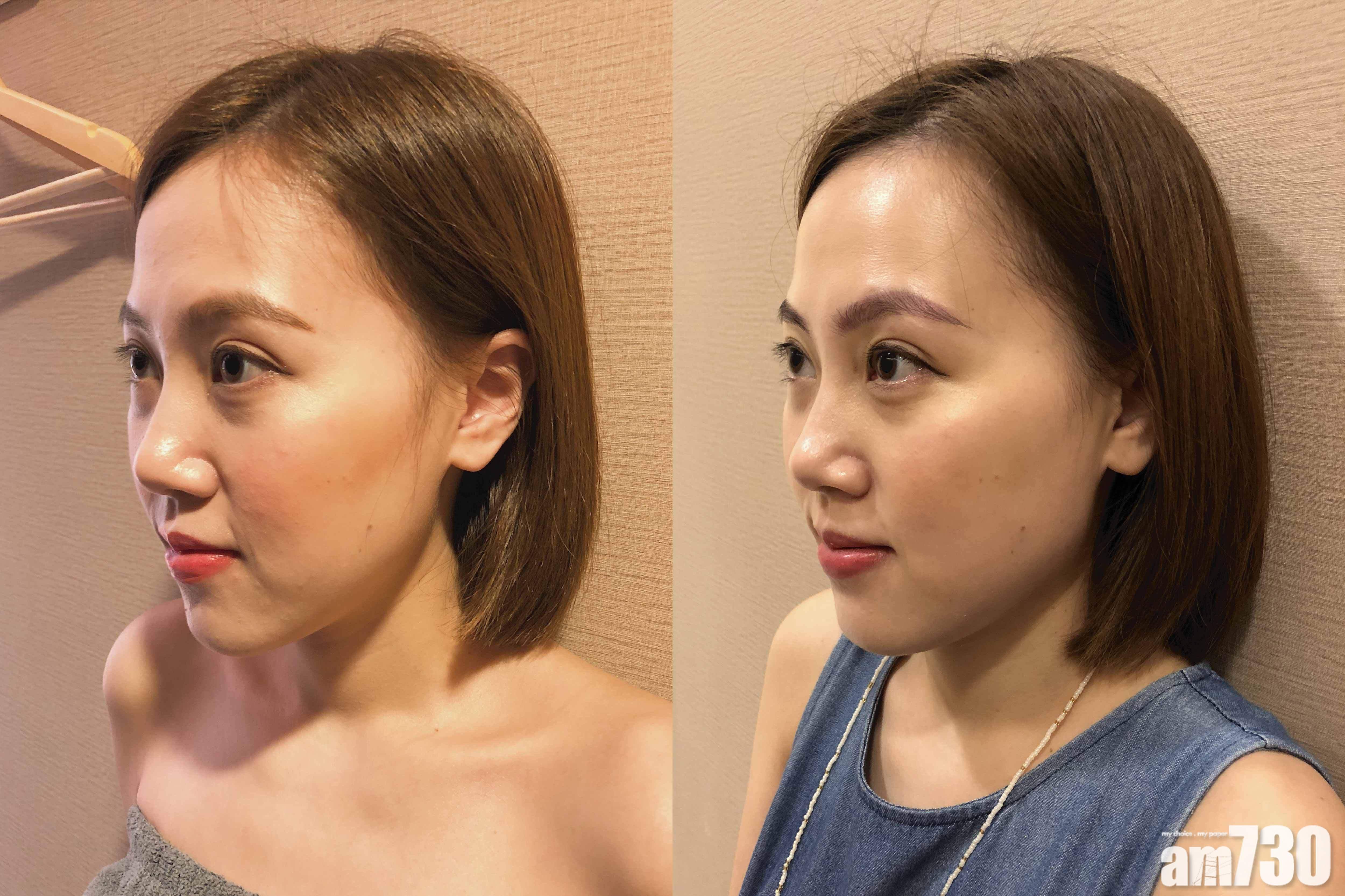 看相片反而易看出不同,法令紋有減淡。