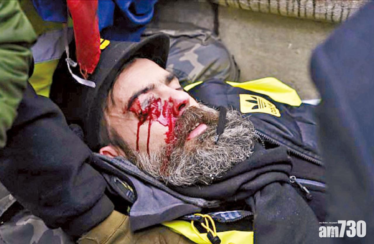 羅德里格斯右眼中彈流血。