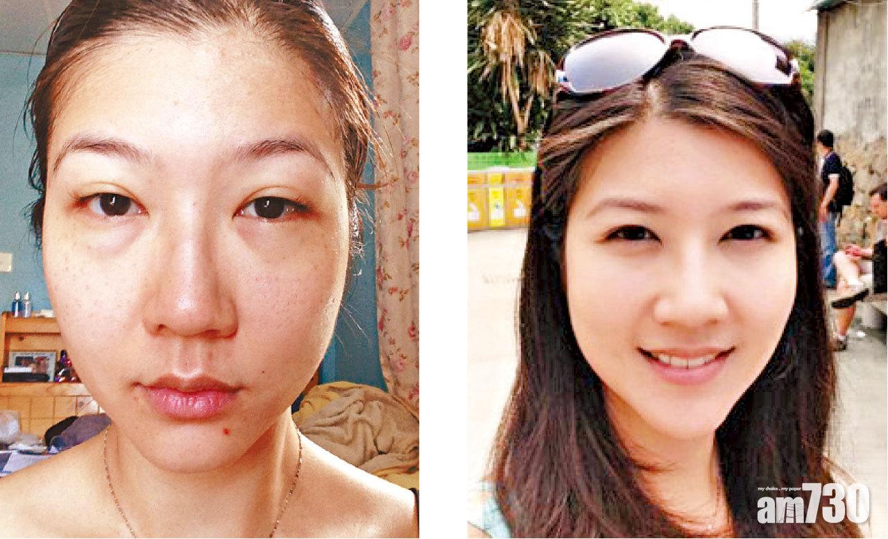 許小姐治療前後分別明顯。