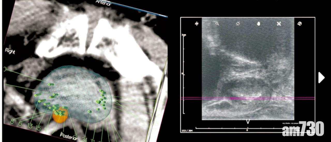 利用最新的正電子掃描,在可疑的前列腺癌組織附近定位(綠色點),找出更準確的抽針位置以作活檢。右圖為同一前列腺位置的超聲波圖像。