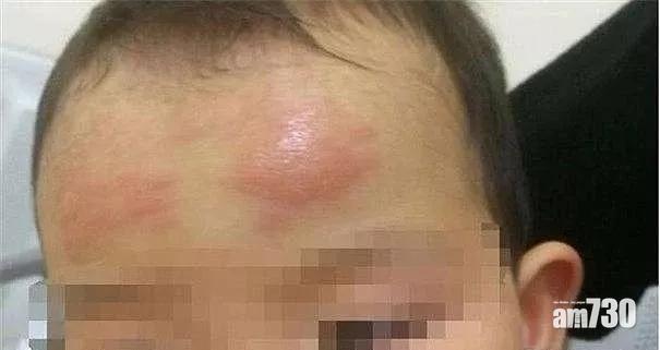 有兒童使用退熱貼後過敏。(互聯網)