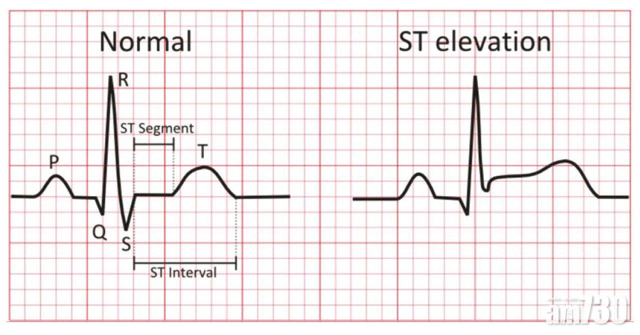 心電圖的ST段若呈上升狀態,是ACS最嚴重的情況。