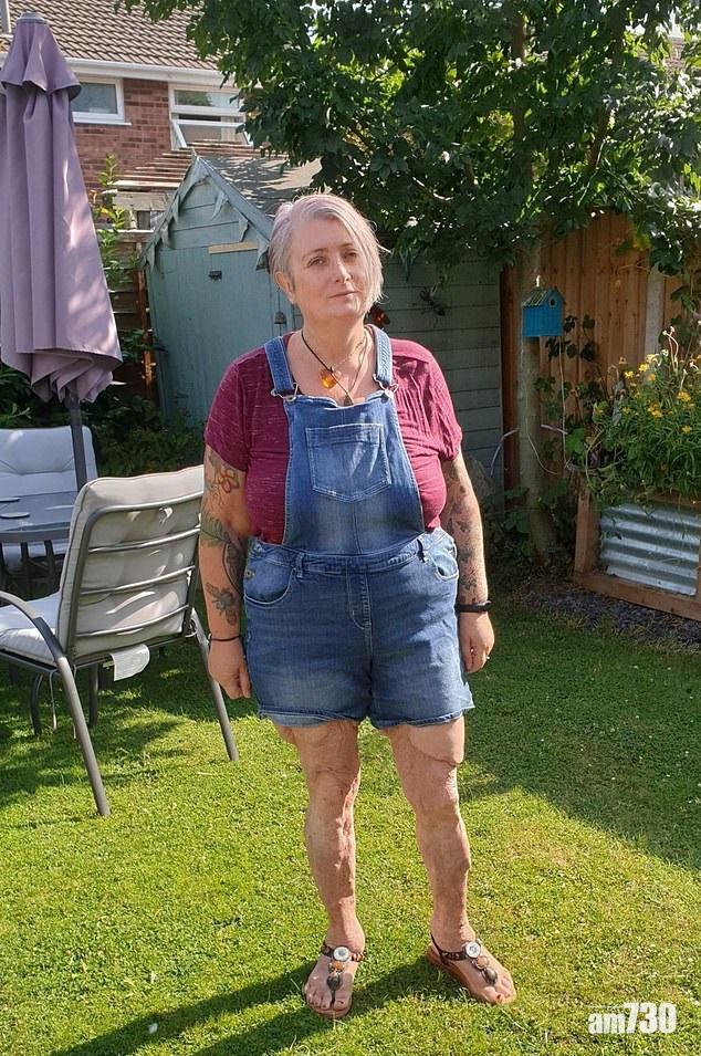 手術後雙腿留下疤痕及凹凸不平。(互聯網)