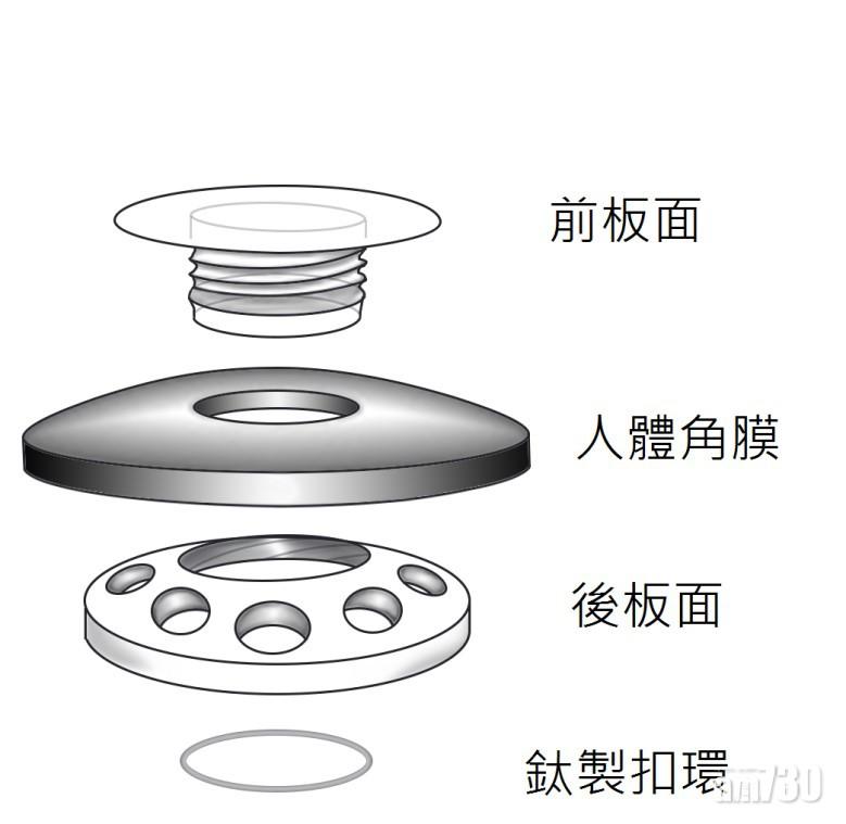 人工角膜的構造(相片來源: EyeWorld.org)