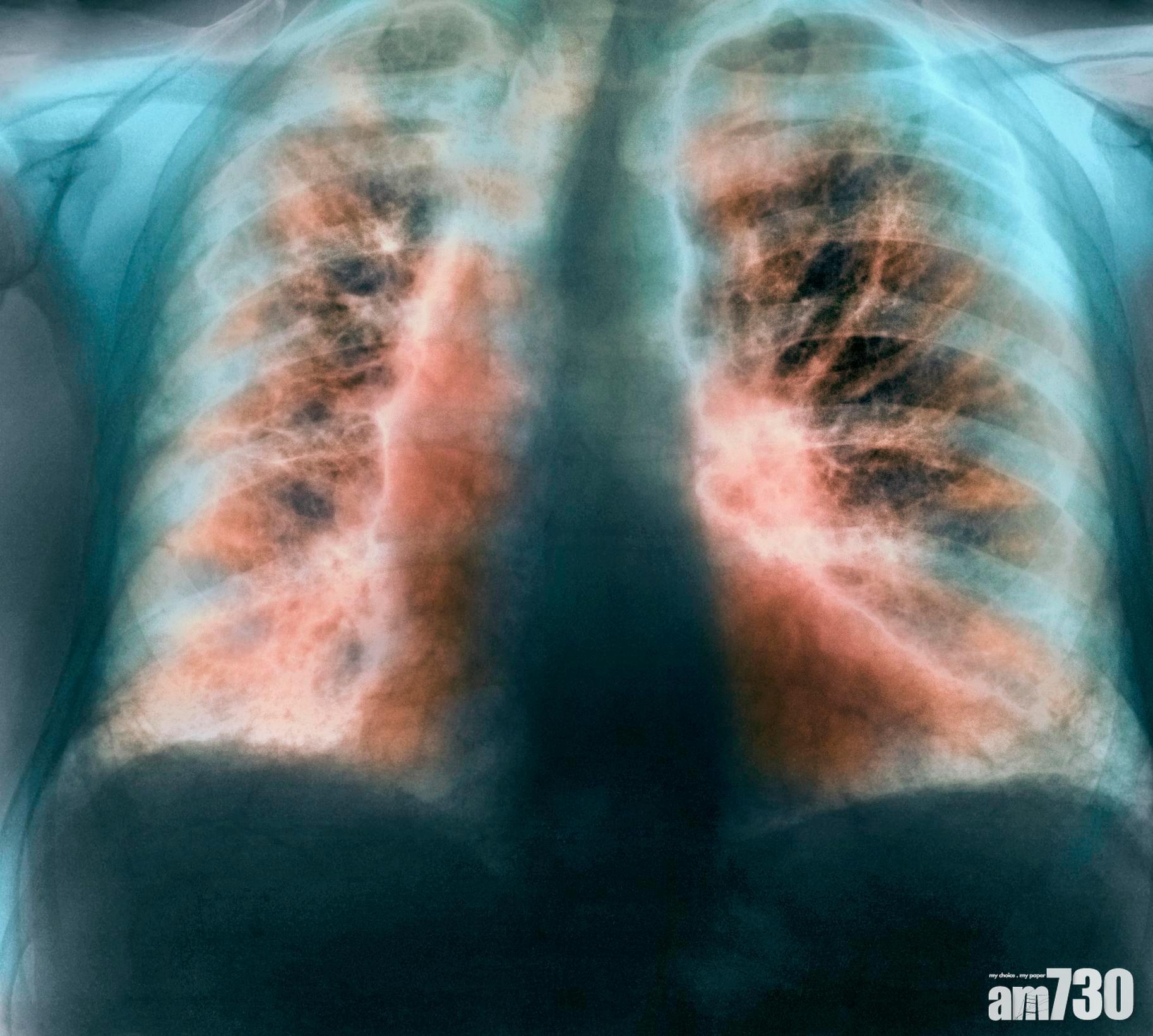 這種病因不明,但持續地肺間質因廣泛纖維化而造成的肺組織增厚,最終令肺部喪失正常氧氣交換功能。(互聯網圖片)