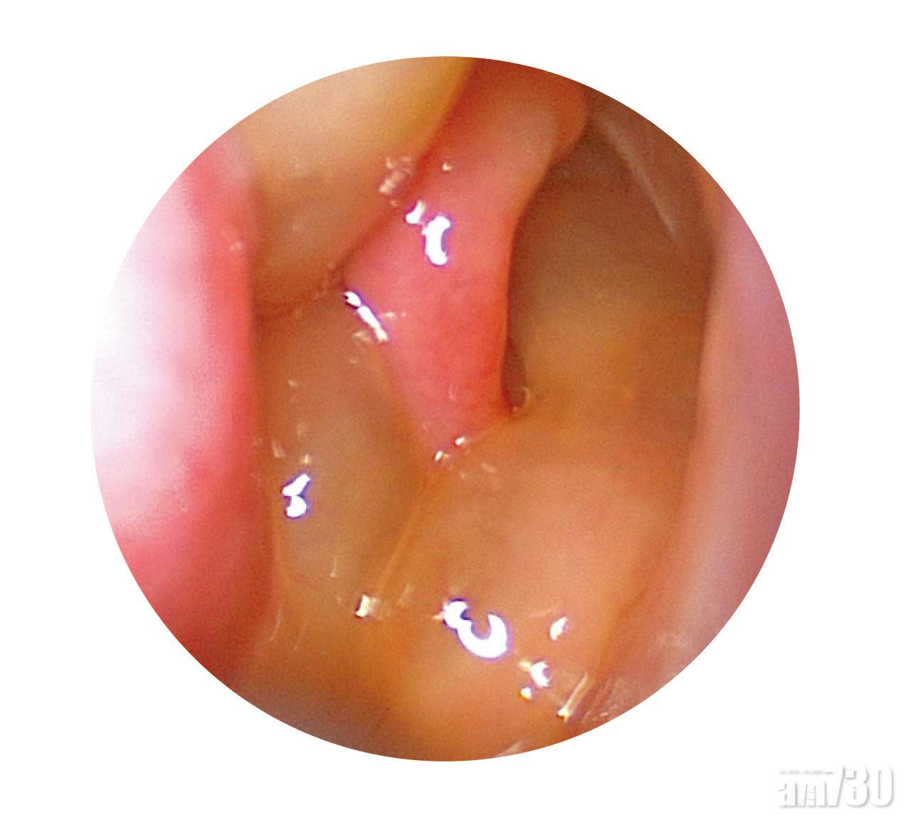 鼻息肉是最常見引致嗅覺消失的原因。