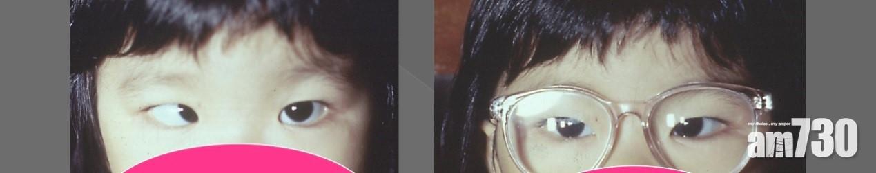 患者透過眼鏡矯正內斜視。