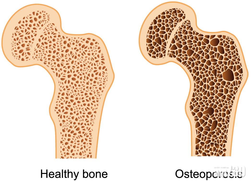 左為健康骨頭,右為骨質疏鬆患者骨頭,由於骨質密度下降,較易出現骨折。