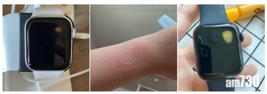 甚至有用戶的手腕被腕錶燙傷。