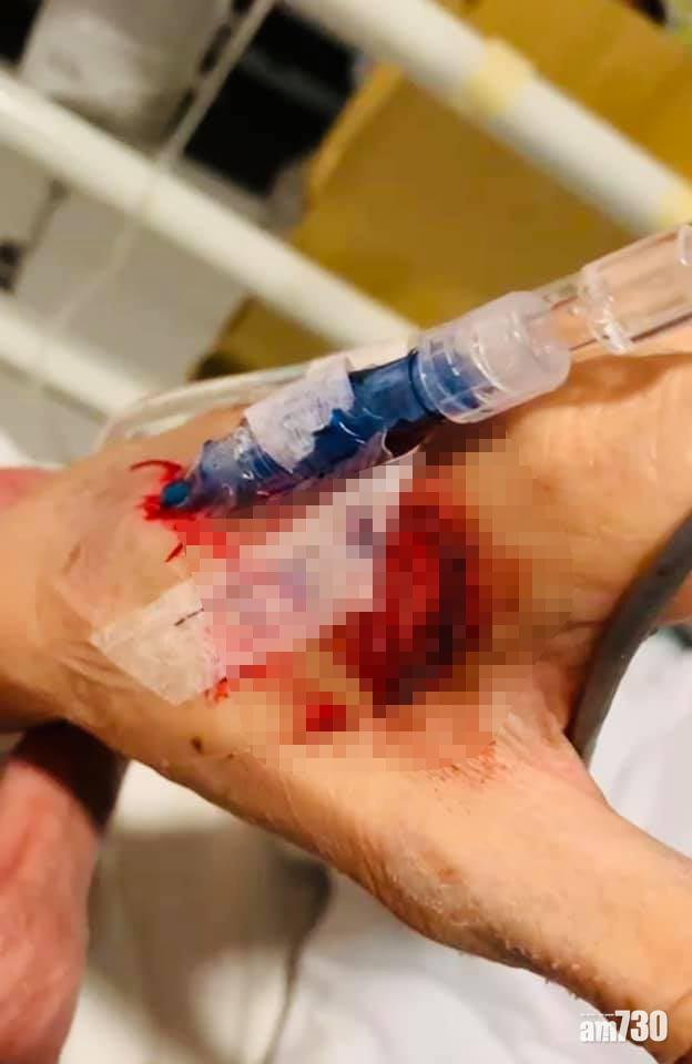 林利發現母親的手部有鮮血及被綁在床上,伊院稱是避免病人跌倒或拔走喉管。