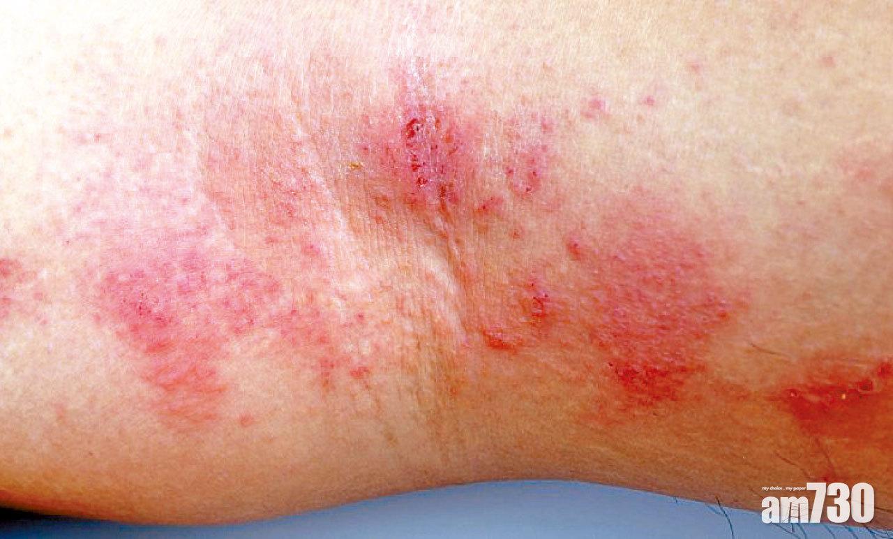 近日天氣再轉冷,小心濕疹發作。
