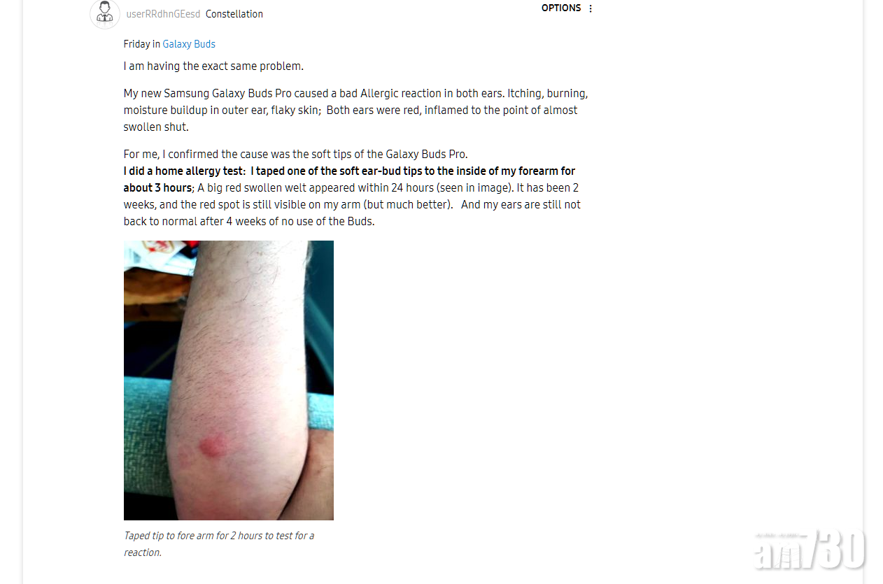 有用戶將耳塞貼在前臂,結果皮膚在 24 小時內出現紅腫。