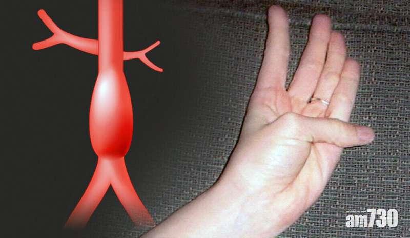 美國耶魯大學的醫學研究人員發現,一種簡單的手部動作,可以提早識別有無主動脈瘤。