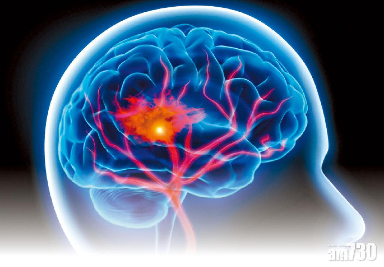 由房顫引起的中風,由於血塊較大影響腦部的範圍也較大,情況一般較嚴重。