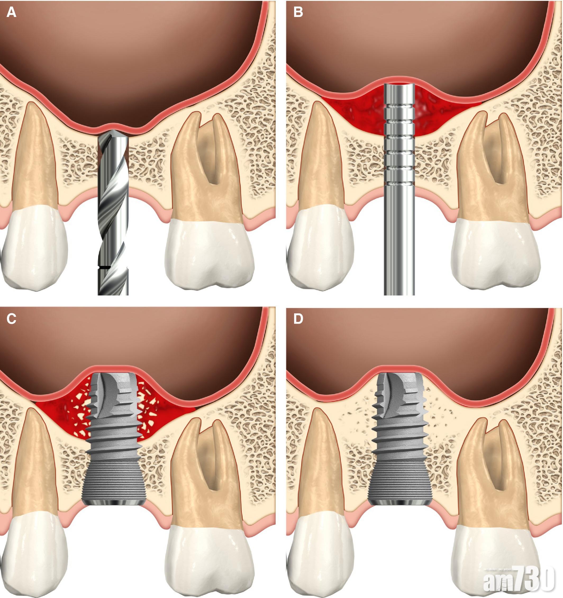 鼻竇提升手術(sinuls floor elevation)。