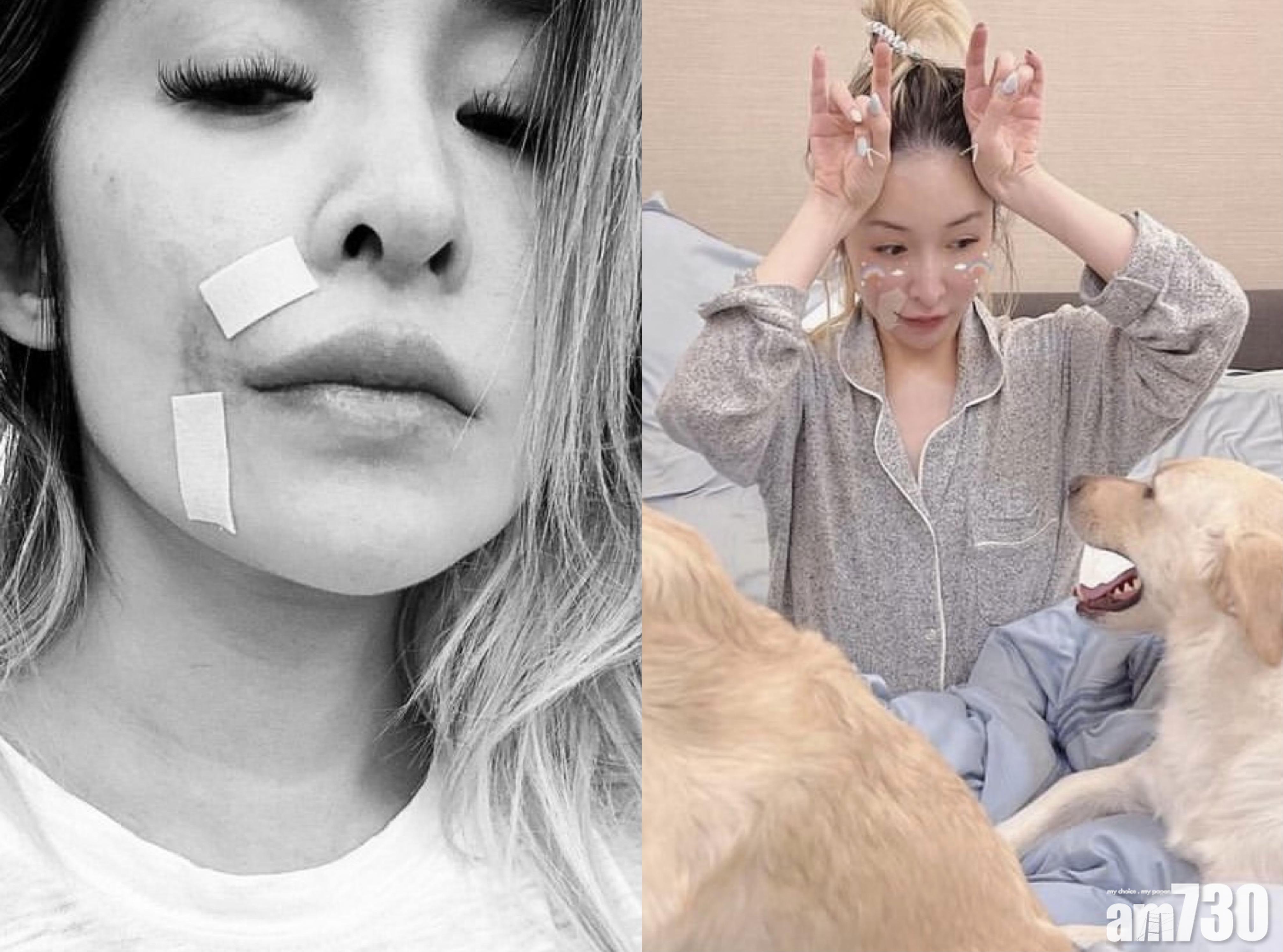 蕭亞軒今年二月在家中遭愛犬咬傷面部。(蕭亞軒@IG)