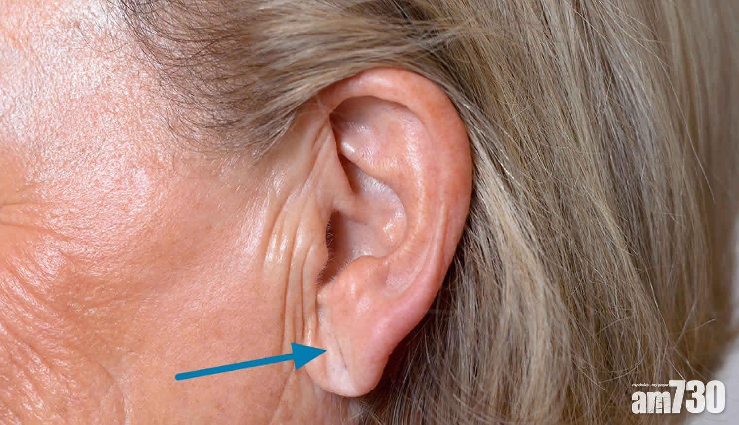 對角線耳垂摺線愈深愈明顯,患冠心病機率愈高。(互聯網圖片)