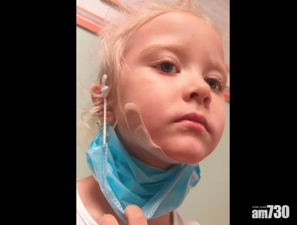 女童面頰被咬傷。(互聯網)