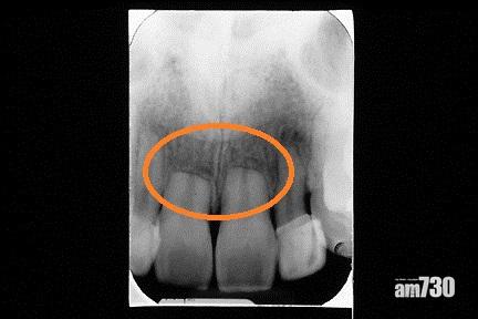 矯齒治療後門牙有牙腳收縮現象(此為嚴重收縮病例)。