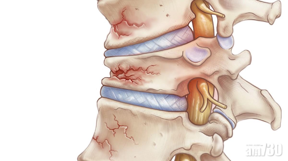 如果骨質疏鬆情況嚴重,脊骨也會骨折。