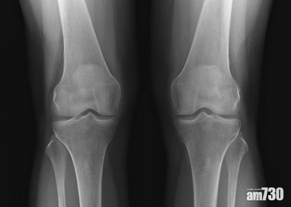 半膝關節置換(右)保留了健康的組織,患者康復後走路的姿勢更自然。(圖片由醫生提供)
