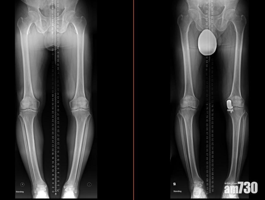 退化性關節(左)的軟骨層遭磨蝕,距離較正常的關節(右)少,嚴重可出現骨磨骨的情況。(圖片由醫生提供)
