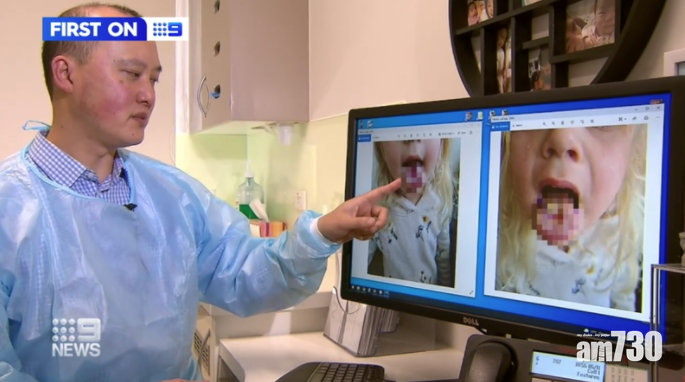 醫生指超酸糖容易灼傷口腔。(互聯網)